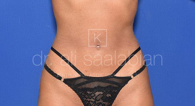 Fettabsaugung, 23 Vorher Nachher