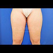 Fettabsaugung, 21 Vorher Nachher