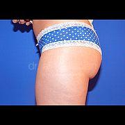 Fettabsaugung, 25 Vorher Nachher