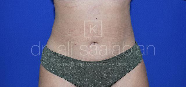 Fettabsaugung, 27 Vorher Nachher