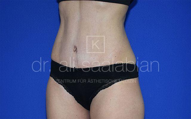 Bauchdeckenstraffung, 46 Vorher Nachher