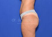 Body Contouring, 26 Vorher Nachher