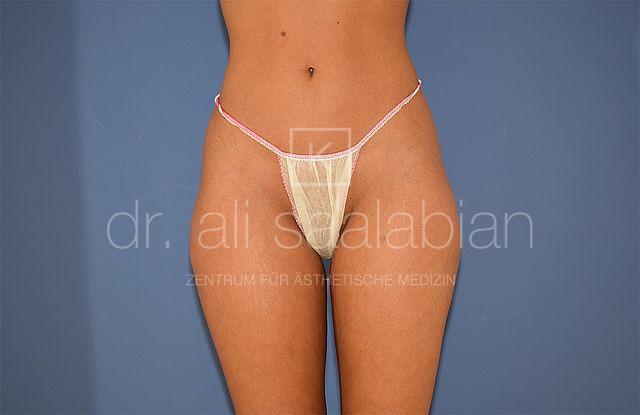 Fettabsaugung, 29 Vorher Nachher