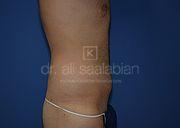 Fettabsaugung, 32 Vorher Nachher