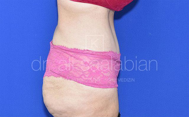 Bauchdeckenstraffung, 46 Vorher Nachher