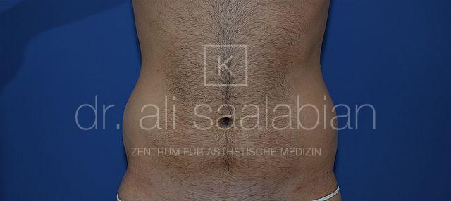 Fettabsaugung, 32 Vorher Nachher