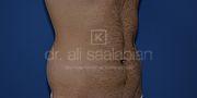 Fettabsaugung, 32 Vorher Nachher
