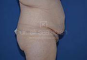 Bauchdeckenstraffung, 32 Vorher Nachher