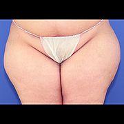 Fettabsaugung, 34 Vorher Nachher