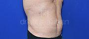Fettabsaugung, 58 Vorher Nachher