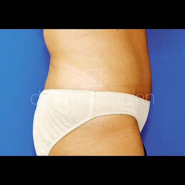 Bauchdeckenstraffung, 50 Vorher Nachher