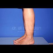 Fettabsaugung, 37 Vorher Nachher