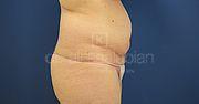 Fettabsaugung, 41 Vorher Nachher