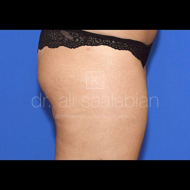 Fettabsaugung, 32 Vorher Nachher