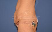 Bauchdeckenstraffung, 38 Vorher Nachher