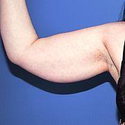 Oberarmstraffung, 50 Vorher Nachher