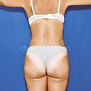 Body Contouring, 26 Vorher Nachher