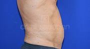 Fettabsaugung, 53 Vorher Nachher