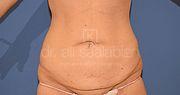 Bauchdeckenstraffung, 38 Vorher Nachher