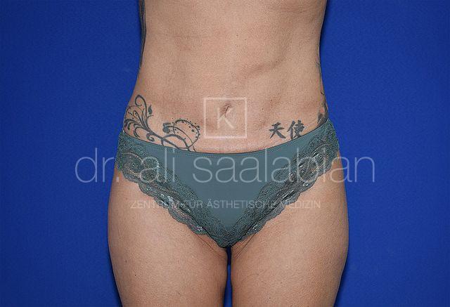 Fettabsaugung, 50 Vorher Nachher