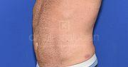 Fettabsaugung, 37 Vorher Nachher
