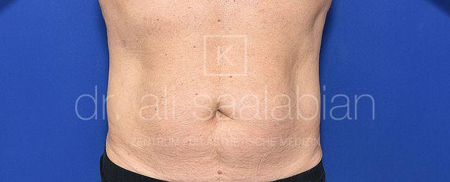 Fettabsaugung, 58 Vorher Nachher