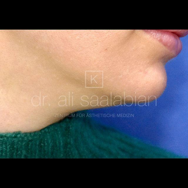 Fettabsaugung, 29 Vorher Nachher