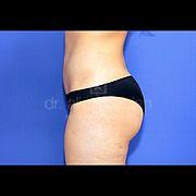 Fettabsaugung, 24 Vorher Nachher