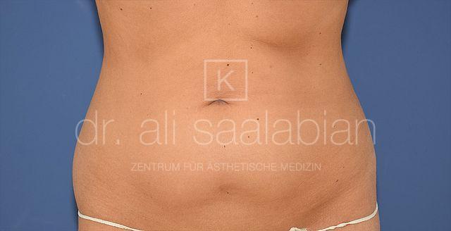 Fettabsaugung, 26 Vorher Nachher