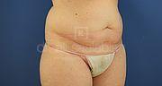 Fettabsaugung, 41 Vorher Nachher