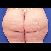 Fettabsaugung, 34 Vorher Nachher