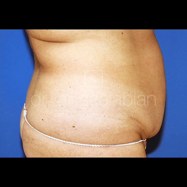 Bauchdeckenstraffung, 50 Vorher Nachher