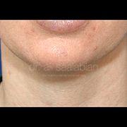 Fettabsaugung, 29 Vorher Nachher