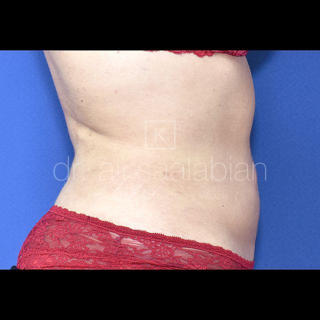 Fettabsaugung, 28 Vorher Nachher