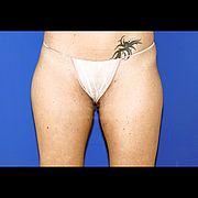 Fettabsaugung, 32 Vorher Nachher