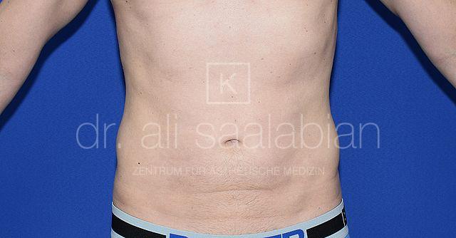 Fettabsaugung, 45 Vorher Nachher