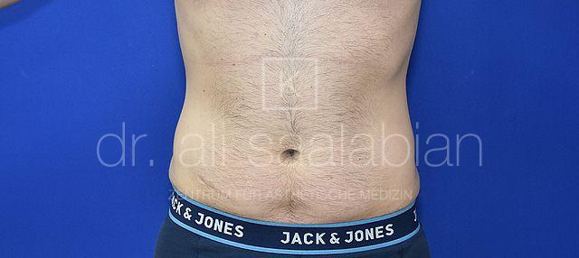 Fettabsaugung, 32 Vorher Nachher