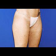 Fettabsaugung, 32 Vorher Nachher