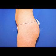 Body Contouring, 20 Vorher Nachher