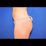 Body Contouring, 20