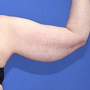 Oberarmstraffung, 50 Vorher Nachher