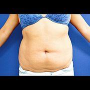 Fettabsaugung, 25 Vorher Nachher