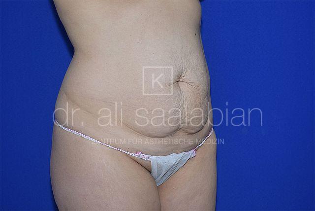 Bauchdeckenstraffung, 35 Vorher Nachher