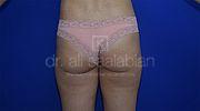 Fettabsaugung, 33 Vorher Nachher