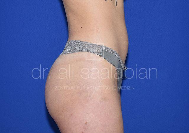 Body Contouring, 20 Vorher Nachher