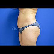 Fettabsaugung, 24 Vorher Nachher