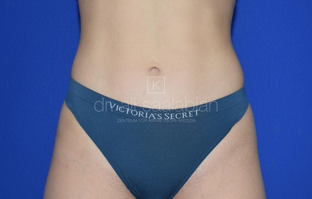 Fettabsaugung, 22 Vorher Nachher