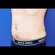 Fettabsaugung, 32 Vorher Nachher