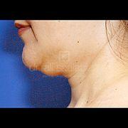 Fettabsaugung, 24 Vorher Nachher