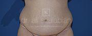 Bauchdeckenstraffung, 32 Vorher Nachher